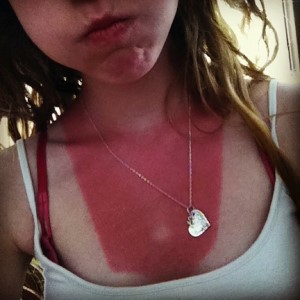 bad sunburn